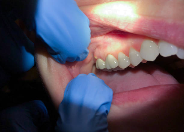 Emergency Dental Fillings